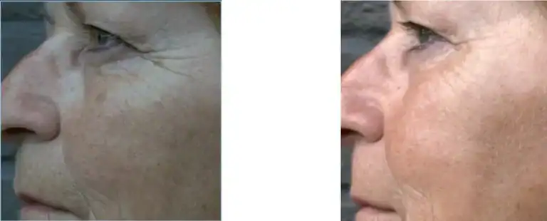 Voor- en nafoto van een vrouw na een Dermashaper behandeling – zichtbare huidverbetering en vermindering van rimpels.